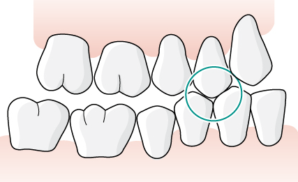 23 (48) Otillräcklig tuggfunktion Det framgår av allmänna råden att otillräcklig tuggfunktion bör anses föreligga när det för tandposition 4-7 på aktuell sida finns färre än två ockluderande tandpar.