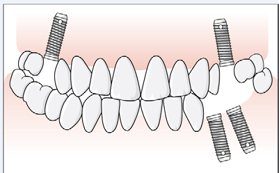 31 (48) Exempel, samtidig operation för ersättningsberättigande implantat och implantat vid utbyte En patient saknar tänder i position 15, 25 och 34-36, i övrigt finns samtliga tänder.