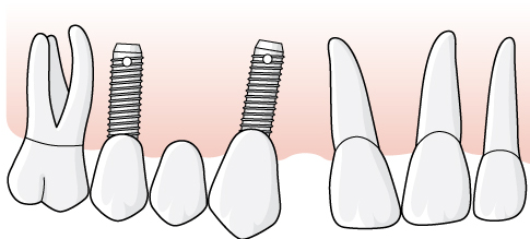 Det finns inga förutsättningar för att uppnå ett långsiktigt hållbart resultat med reparation. Tandläkaren föreslår att en ny suprakonstruktion utförs, distanserna kan behållas.