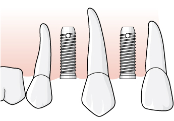 2 lämnas tandvårdsersättning endast för implantat inom tandposition 5-5 eller för ett implantat i tandposition 6 om ett implantat inte kan placeras inom tandposition 5-5.