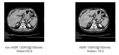 Iterativa rekonstruktionsalgoritmer GE: ASIR (Adaptive Statistical Iterative Reconstruction) Siemens: IRIS