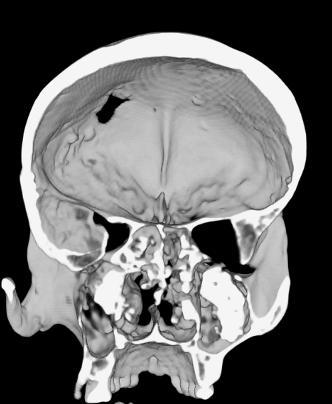 tafonomiska orsaker. Dock ses oregelbundenhet på utsidan av nasalbenen; huruvida detta beror på syfilitiska förändringar eller trauma låter jag vara osagt.