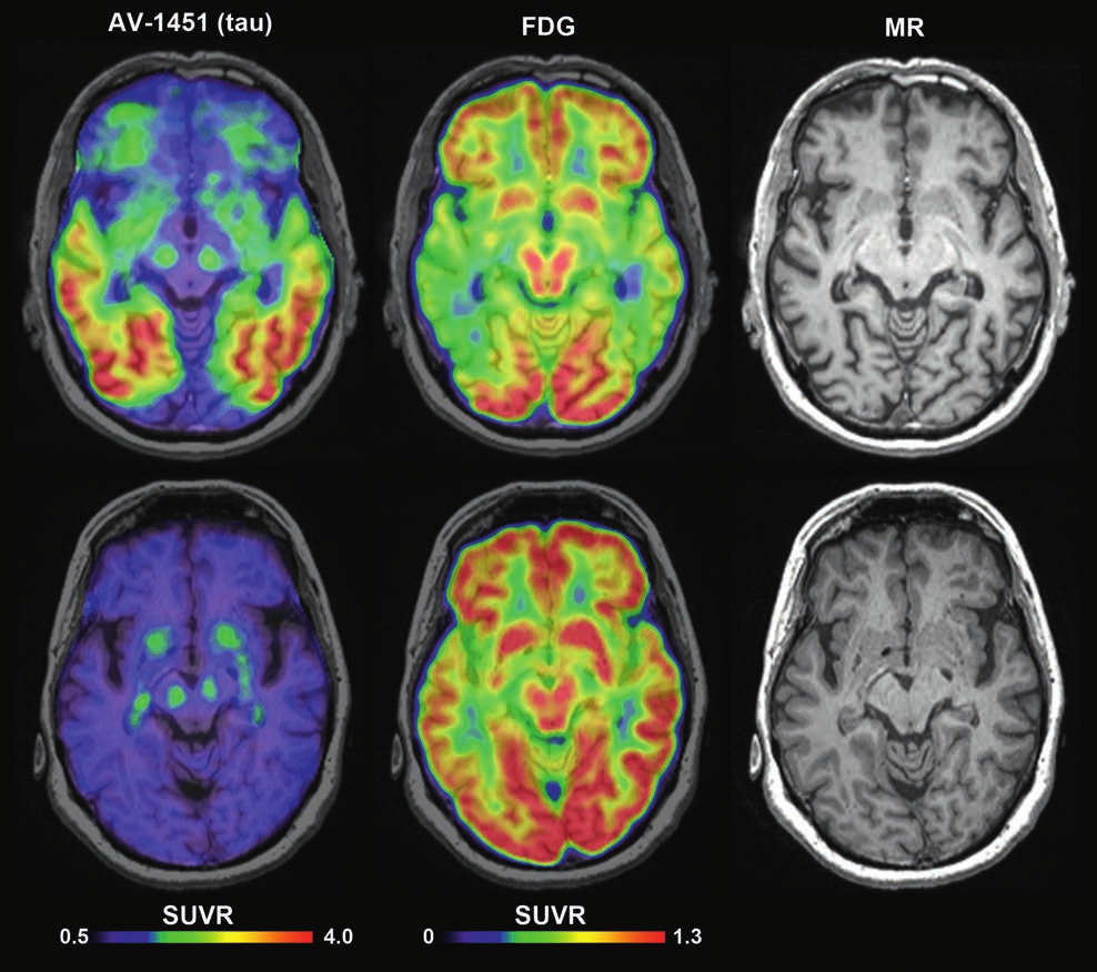 Alzheimer tienterna börja ansamla amyloid i hjärnan.