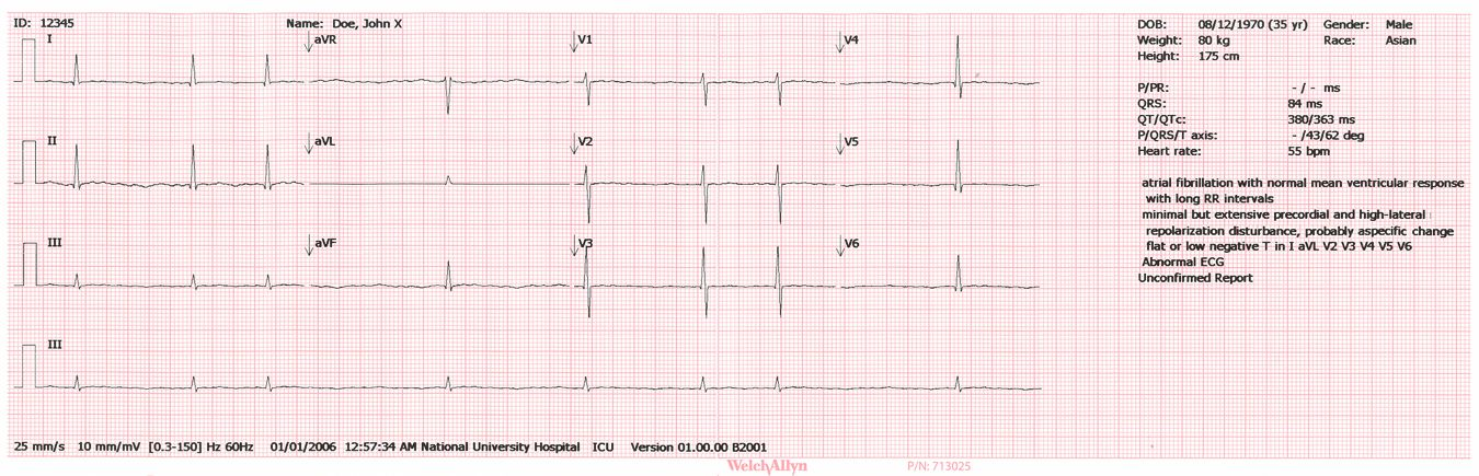 2 Introduktion CP 50 och CP 50 Plus EKG-apparat med 12 avledningar för vilo-ekg Om undersökningstyperna Auto-EKG En rapport som vanligtvis innehåller en 10-sekundersregistrering av ett