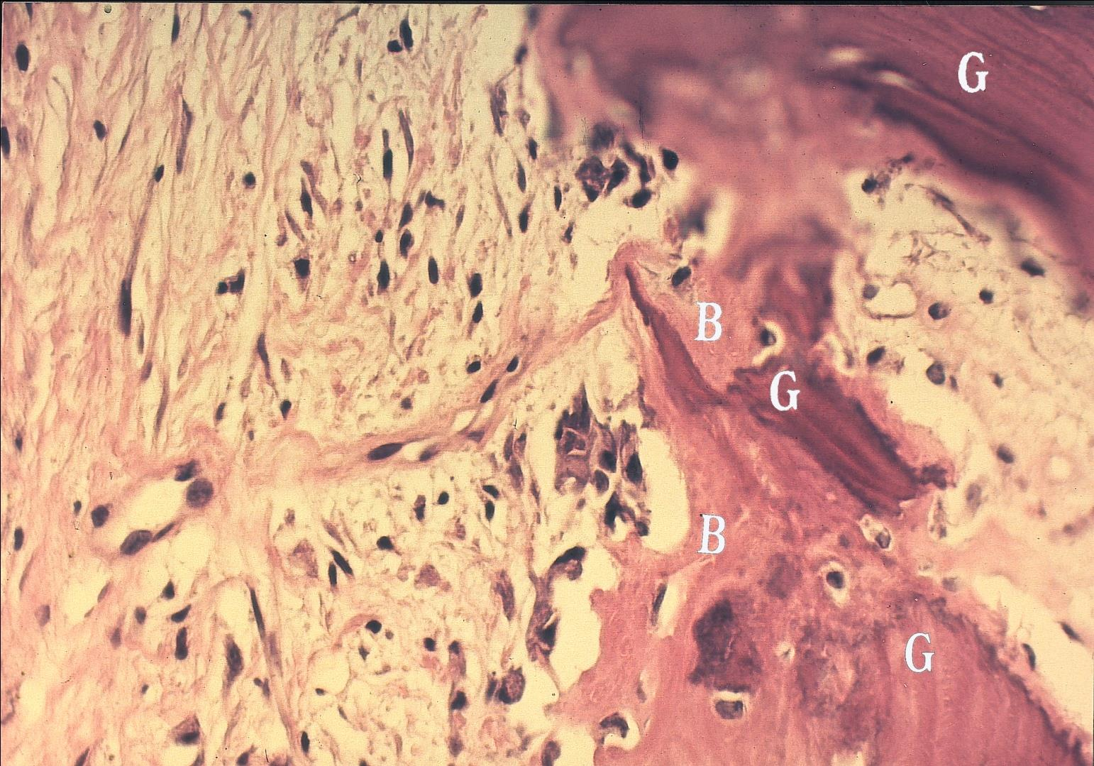 Histologi resultat. Ref. Ullmark G, Obrant KJ. Histology of impacted bone-graft incorporation. J Arthroplasty.