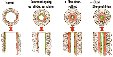 Astma Inflammation i luftrören sammandragning