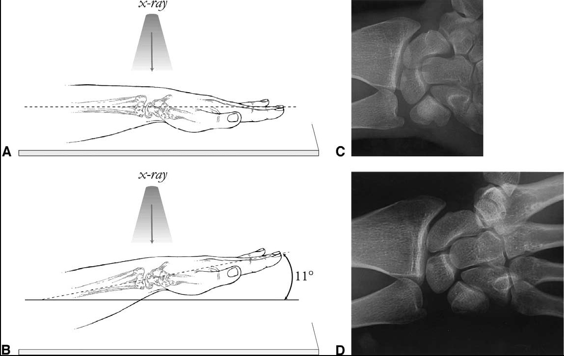 HANDLED - frontal Kriterier Distala radius och ulna samt minst hälften av metacarpalben ska vara avbildade. mjukvävnad ska ses Specifikt; Radius ska ses frontalt (dvs.