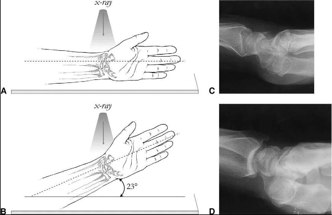 Radius ska ses lateralprojicerad och ulna frontalprojicerad (dvs. procesus styloideus ulnae ses nästan mitt i ulna. (Obs!