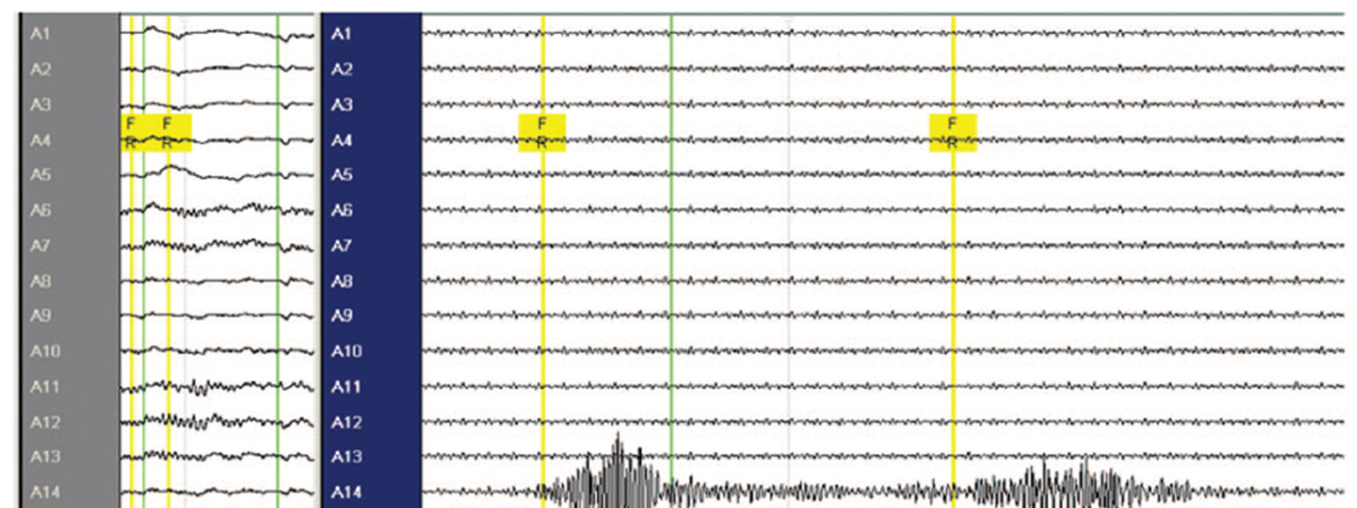 REGISTER OCH UTVÄRDERING AV RESULTATEN EFTER KIRURGISK EPILEPSIBEHANDLING RAPPORT ÖVER VERKSAMHETEN ÅR 2013 HFO (high frequency oscillations) är ett