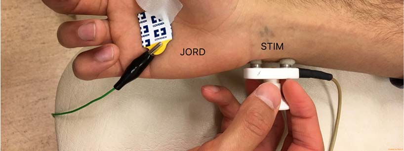 interphalangeal led (REF i figuren), jordelektroden i handflatan (JORD i figuren) och stimuleringselektroden över n ulnaris (STIM i figuren) 80-110 mm proximalt om registreringselektroden i