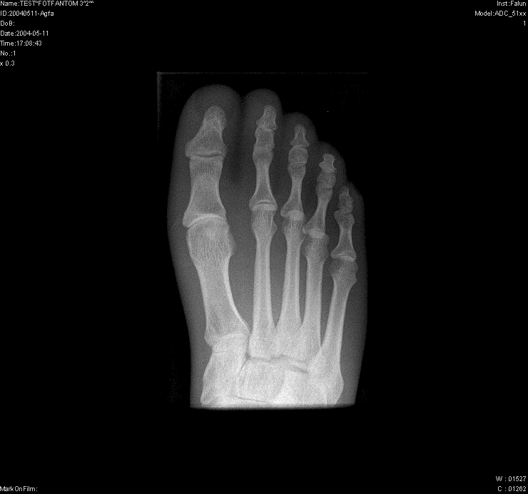 MÄTNINGAR 4.2.3 Fotfantom En undersökning av fot är inte av lika stort intresse som föremål för en sänkning av dos då en fot inte innehåller några märkbart strålkänsliga organ.