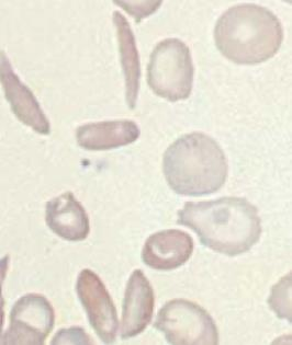 Sickle cell anemi - symtom Anemisymtom Mikroinfarkter bl.a. I mjälten som atrofierar.