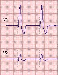 Fånga en händelse CardioPerfect Workstation När du upptäcker en händelse, t.ex. arrytmi, under en inspelning kan du fånga den på EKG:et.