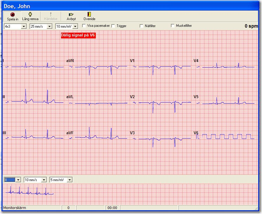2.13 Indikering av signalkvalitet CardioPerfect Workstation Om CardioPerfect Workstation upptäcker att signalen från en av kanalerna är oriktig, om den till exempel kommer från en elektrod som
