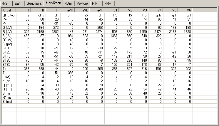 Mätdatavy Vyn Mätdata visar de mätdata som samlats in av datorn. Dessa mätdata omfattar värdena för ett flertal vanliga parametrar, t.ex. Q-, R- och S-amplituden samt ST-värdena.