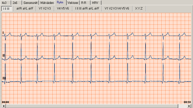 Rhythm view (Rytmvy) När du har spelat in ett rytm-ekg kan du granska hela EKG:et i Rhythm view (rytmvyn). Du kan använda rullisten när du går igenom EKG:et.