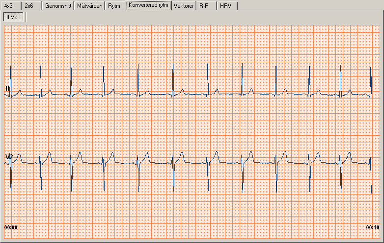 Gammal rytm-remsa Vyn Gammal rytm-remsa finns endast för EKG som spelades in med äldre versioner av programvaran Workstation (programvara från före år 2000).