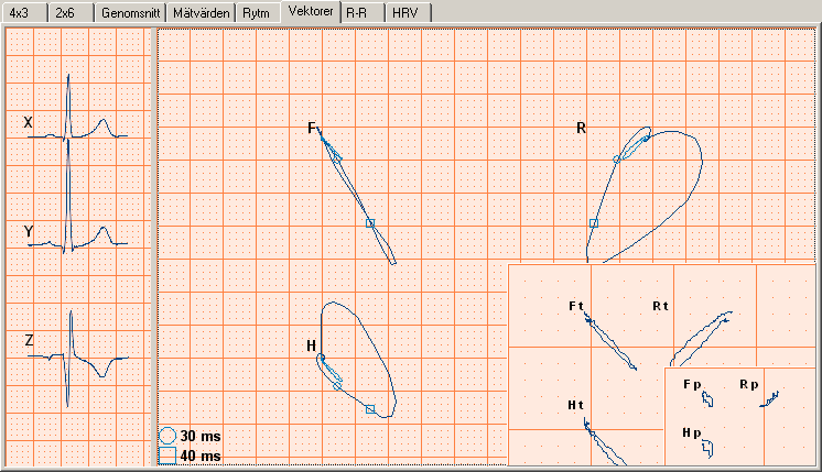 Den visar resultaten från ett EKG i ett vektorkardiogram. I den vänstra rutan visas de rekonstruerade ortogonala avledningarna x, y och z.