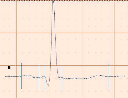 4.12 Använda ett växelströmsfilter CardioPerfect Workstation EKG-signaler kan innehålla brus som orsakats av interferens från huvudströmmen. Detta gör att signalerna blir svårare att läsa av.