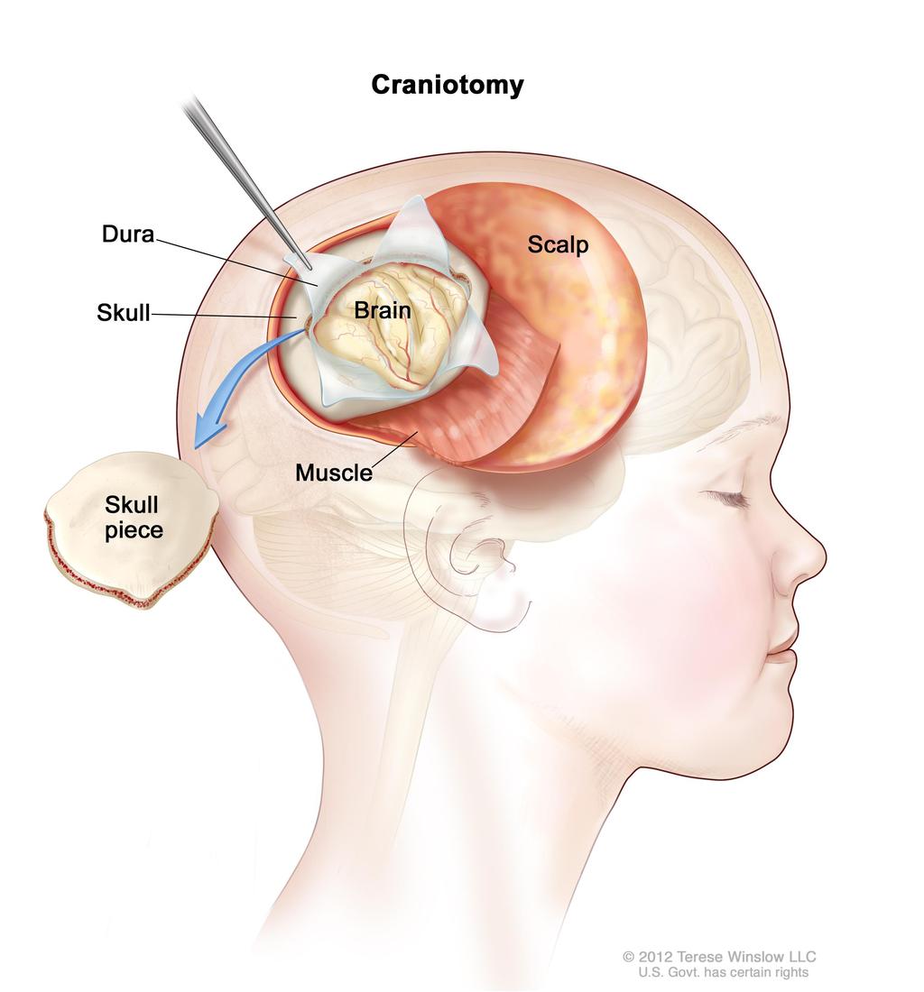 10-årig flicka med aggressiv hjärntumör. Återfall efter operation, strålbehandling och cytostatika.
