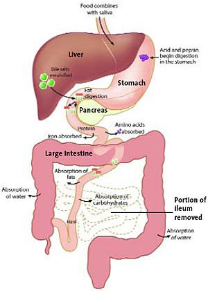 Tarmundergång på grund av intrauterin kärlkatastrof. <20-25 cm tunntarm kommer aldrig att klara sig på mat via tarmen.