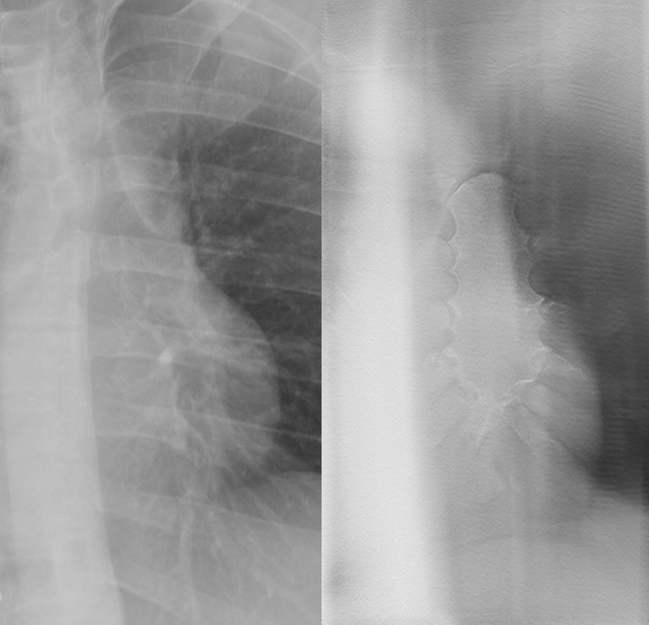 vanligt röntgenstativ mammografistativ C-båge angiografistativ Historik Matematisk bakgrund 1917 (Radon) Analog tomografi 1932