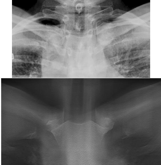 9% / 100% Besvärlig anatomi 35 consecutive patients 2 week