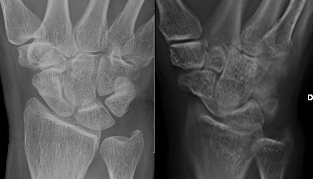 fracture Radiography: 1 waist fracture, 1 avulsion of