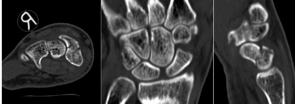 Tomosynthesis: 2 additional waist fractures, not seen with