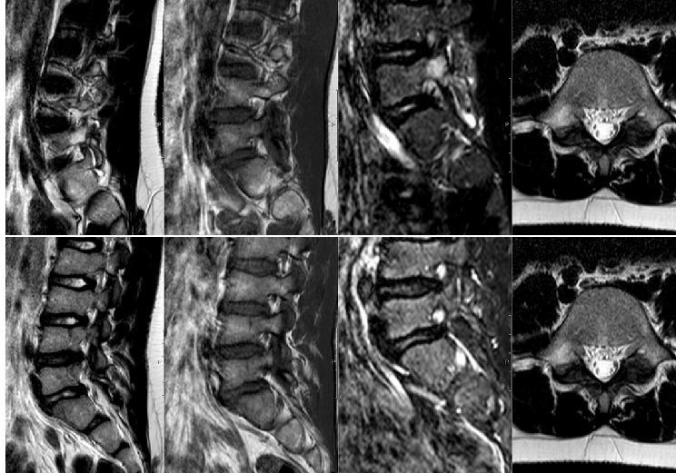 Spondylolys DX SIN