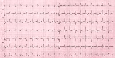 Fråga 8 Till akutmottagningen söker en 57 årig man efter att han svimmade imorse vid frukostbordet. För 2 veckor sedan opererade han ett ljumskbråck. EKG enligt nedan. (OBS ej i skala) B.