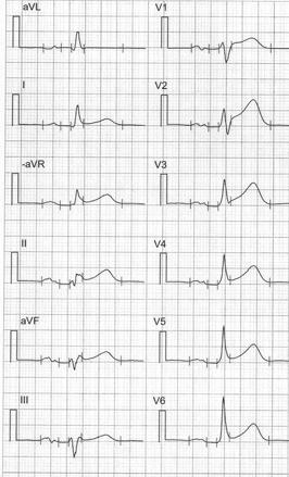 Fråga 12 Du arbetar som hjärtjour på akutmottagningen. Din nästa patient är en 30 årig man rökare, tidigare frisk som söker på grund av bröstsmärta.
