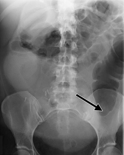 normala bråckportar. Du ordinerar 2 l vätska intravenöst, V.sond, smärtstillande, och syrgas. Du ordinerar också LAB prover akut: Hb/Hematokrit, CRP/Lpk, S-Na, S-K, Krea och en CT BÖS.