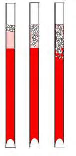 Felsökning 11.9.2. Skum i kolumnen Ett lager luftbubblor som samlats längst upp i blodkolumnen påverkar inte själva sedimenteringsprocessen. Sedimenteringen utvecklas vanligtvis under bubblorna.