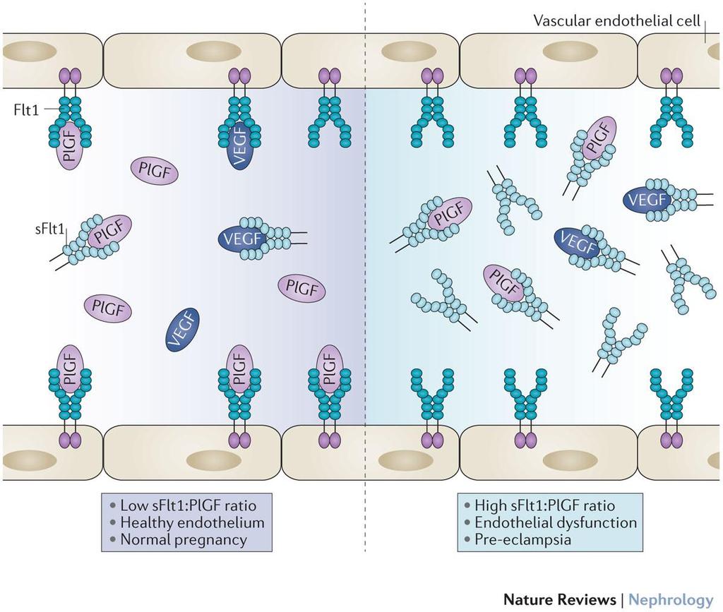 sflt-1 and PlGF in preeclampsia Zeisler, H N. Engl. J. Med. 374, 13 22 (2016). Levine, R. J. et aln.