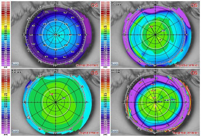 1.3.3.1 Användningsområden och funktioner Bon Sirius kan bland annat utföra corneal pachymetri, meibografi, pupillografi, göra IOL beräkningar, keratokonusscreening och uppföljning, glaukomanalys (Bon.