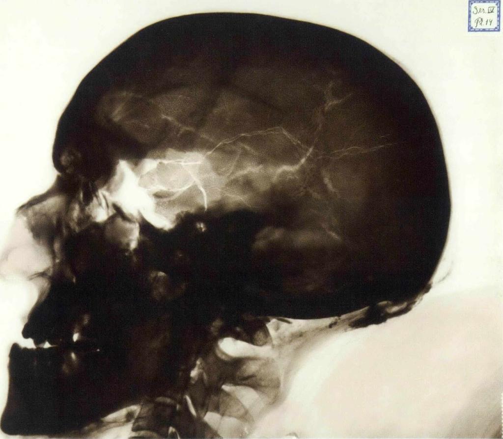 Röntgenbild av Karl Xll:s skalle. Krigarkungens grav öppnades när Riddarholmskyrkan i Stockholm skulle renoveras 1917.