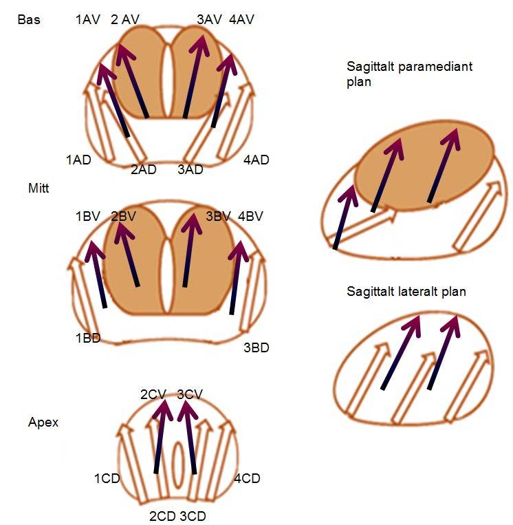 Figur 6: Förslag till biopsiernas placering vid en första och andra biopsiomgång. Pilarna utan fyllning representerar den första biopsiomgången och de mörka pilarna den andra gången.