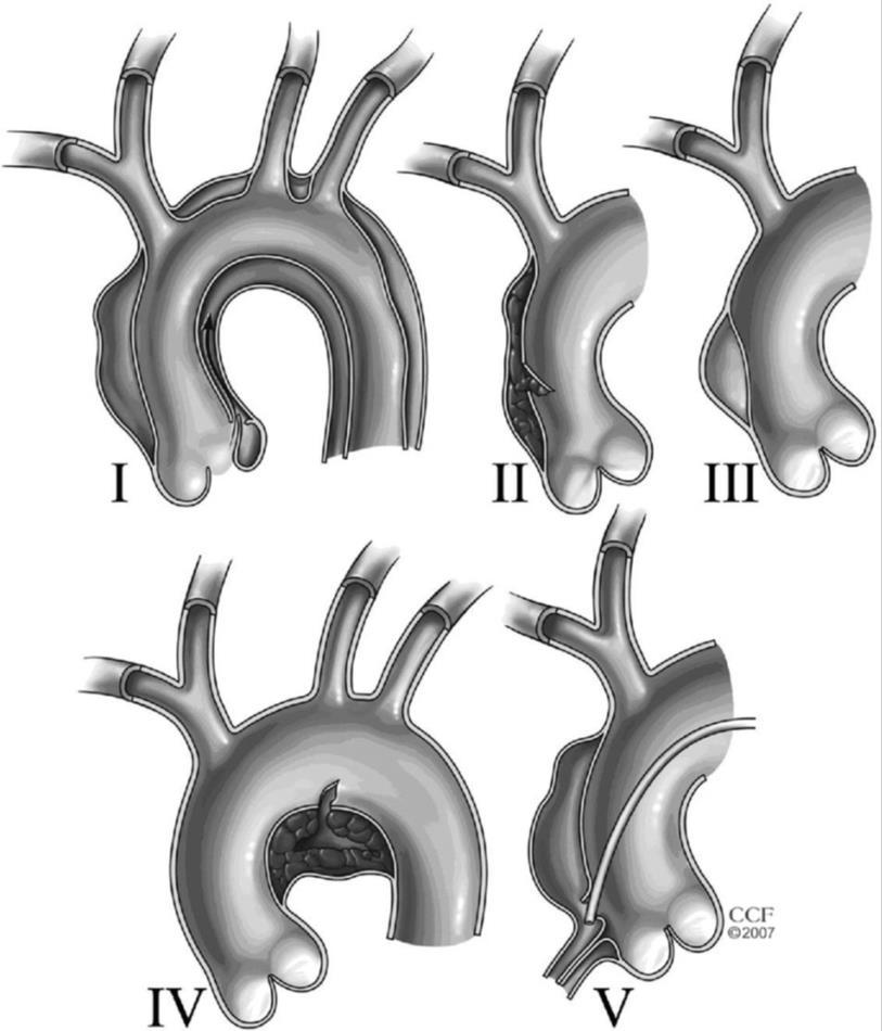 Aortadissektion - klassifikation I. Klassisk dissektion m intimaflap mellan äkta och falskt lumen (90%) II. Intramuralt hämatom (10%) III.