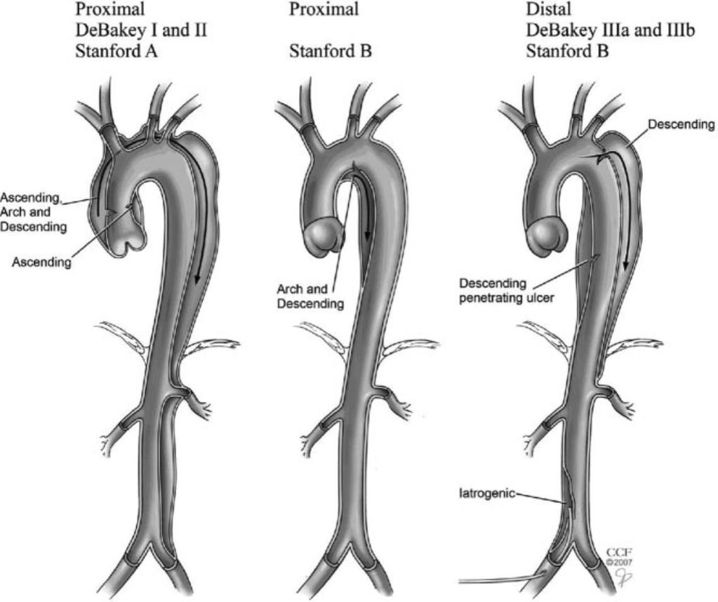 Aortadissektion - klassifikation Proximal = Ascendens = Typ A + ev övriga aorta Typ I = Ascendens + övriga Typ II = Enbart