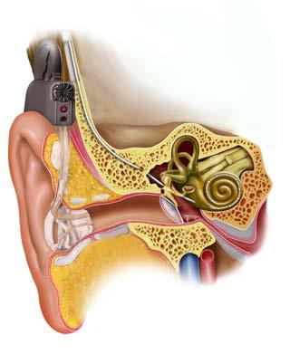 Electric acoustic stimulation Försiktig implantation Kombinerar HA med CI (~8 electrodes) HA i de