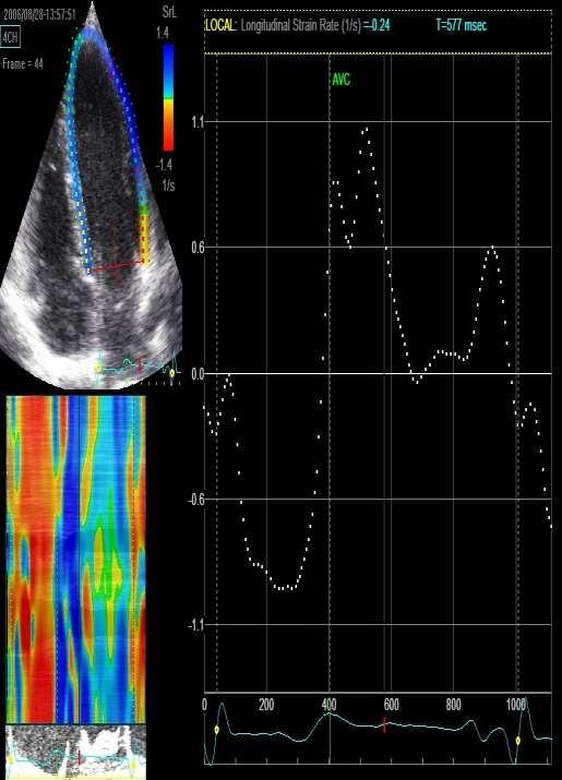 Systolic LV