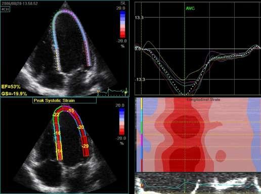 2D Speckle Tracking 2D Strain Pat 1 Pat 2 (