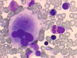 Immunologisk trombocytopen purpura Autoantikroppar mot trombocyter och megakaryocyter Ofta snabb debut och grav isolerad trombocytopeni Uteslutningsdiagnos infektion annan autoimmun sjukdom primär