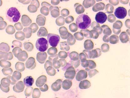 Myelodysplastiska syndrom En heterogen grupp av myeloiska stamcellssjukdomar Klonal