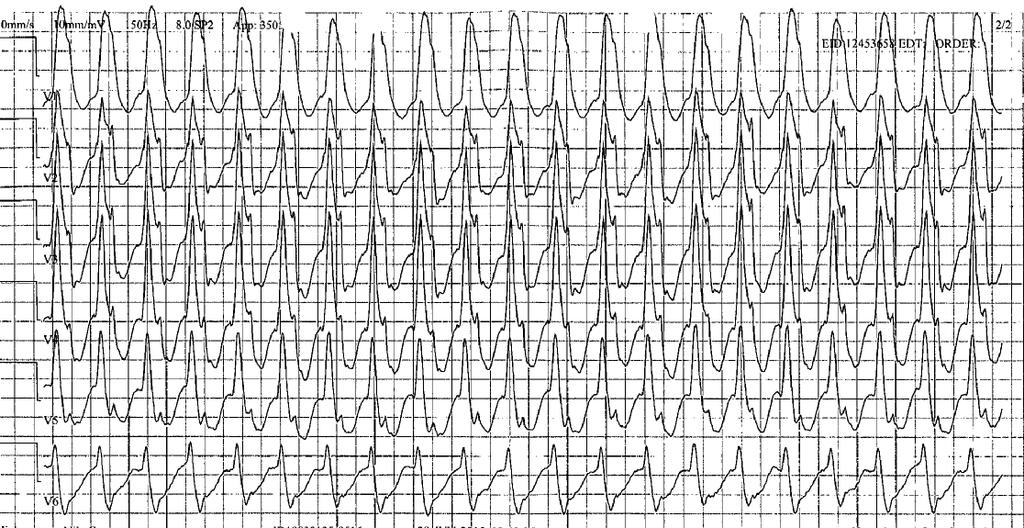 Fall 2 EKG