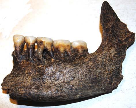 Fig. 29. Vänster underkäke från den vuxna individens i grav AA 19173. Lägg märke till abscessen under M 1.
