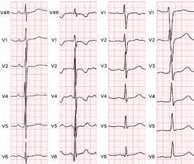 ABC OM Pediatrisk EKG-tolkning EKG används på barn vid utredning av t ex misstänkta arytmier, bröstsmärta, synkope, intoxikationer och medfödda hjärtfel.