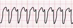 hos barn skiljer sig markant från hos vuxna. Nyfödda har positiva T-vågor i V (och V3R) som inverteras under den första veckan. I V2 V3 är de negativa redan vid födseln.