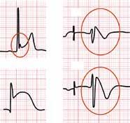 eller ses vid kardiomyopati och läkemedelsbiverkan [20]. Vid sinusarrest ses utebliven P-våg med efterföljande isoelektrisk linje till dess att en ersättningsrytm alstras.